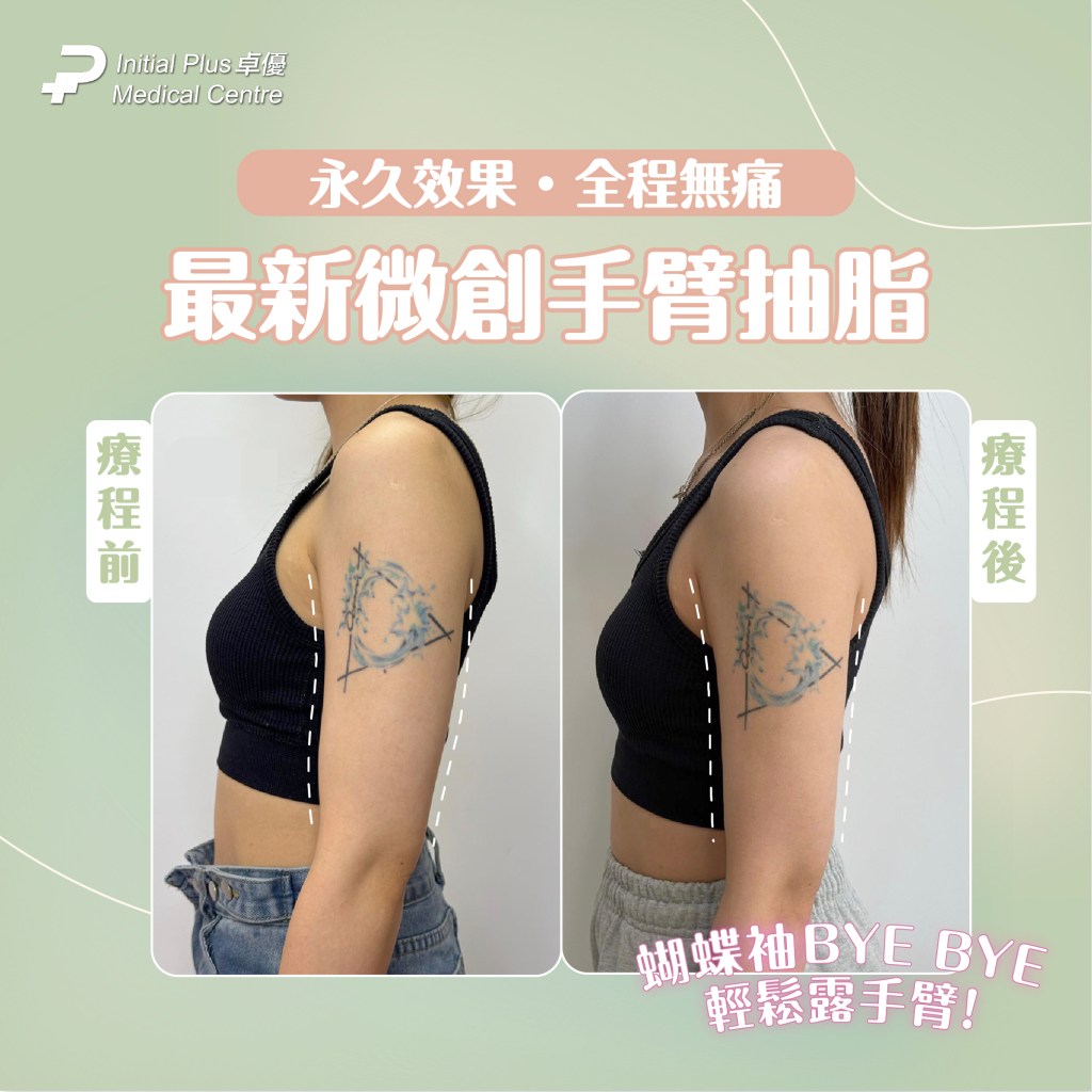 Initial Plus Medical Centre 卓優醫療診所 手臂抽脂對比圖