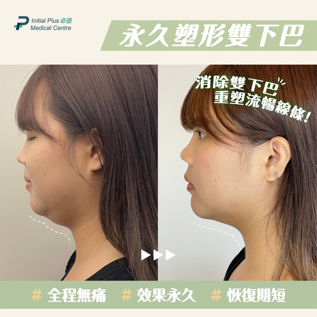 Initial Plus Medical Centre 卓優醫療診所 雙下巴抽脂對比圖2