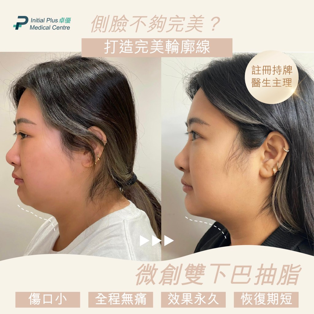 Initial Plus Medical Centre 卓優醫療診所 雙下巴抽脂對比圖3