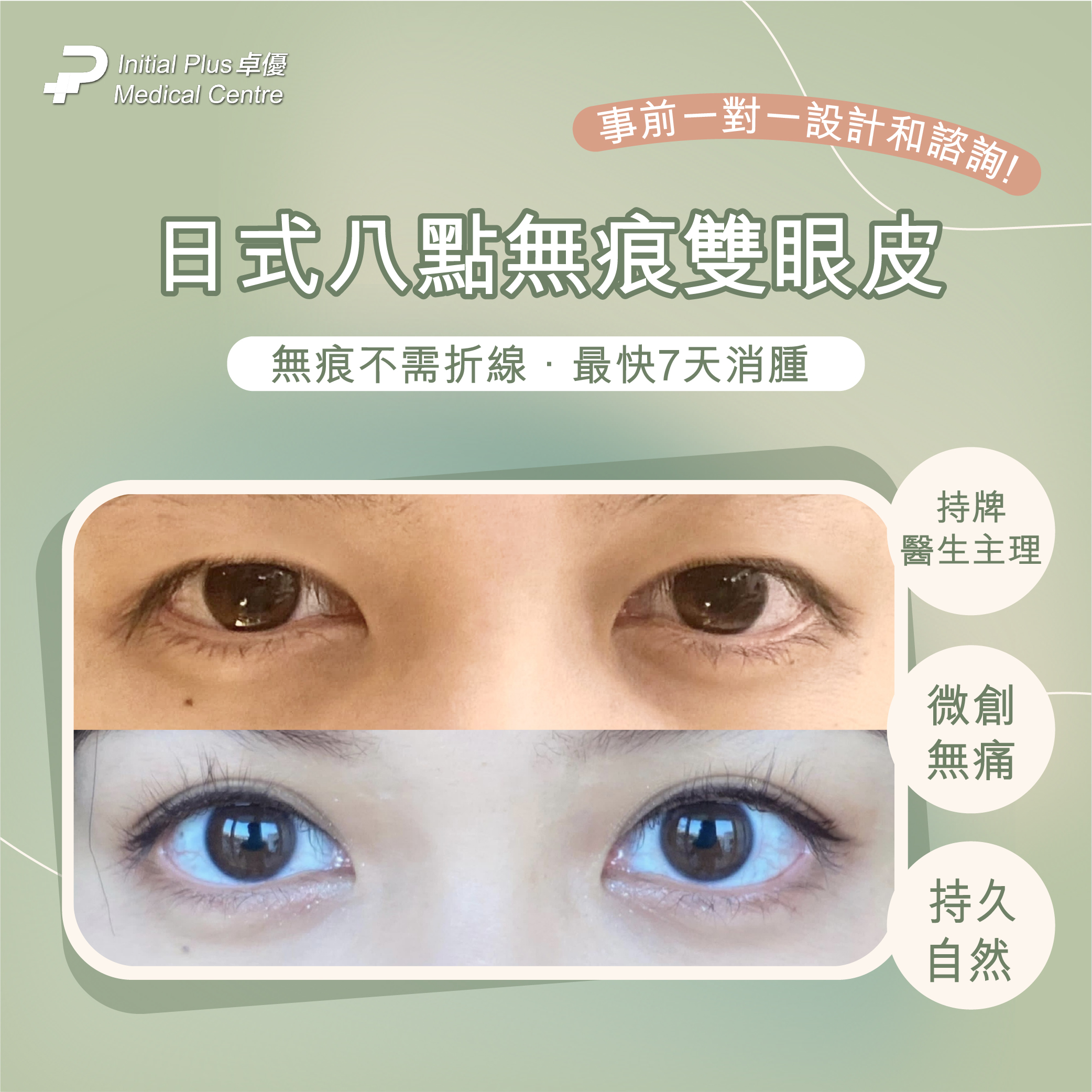 日式8點無痕雙眼皮 1 日式8點無痕雙眼皮