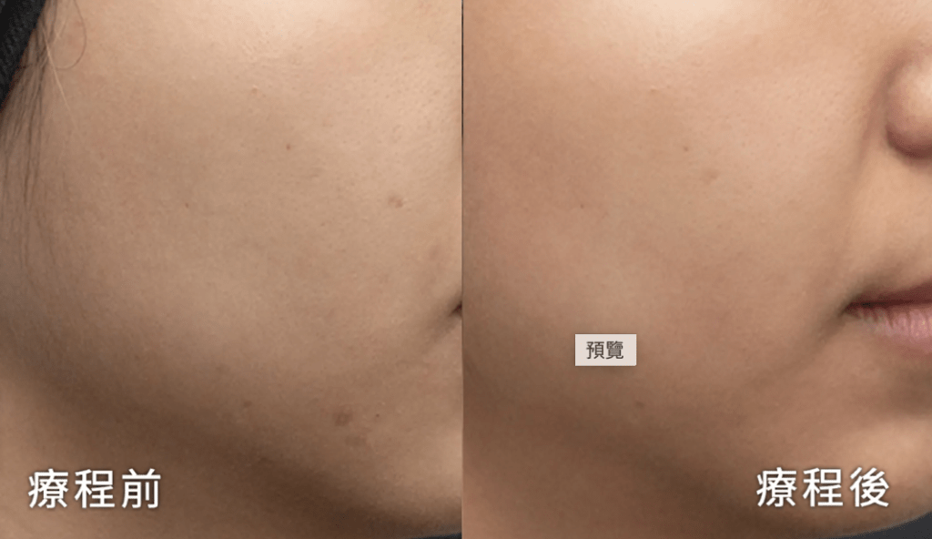 Initial Plus Medical Centre 卓優醫療診所 Belotero Revive 保濕水光針對比圖