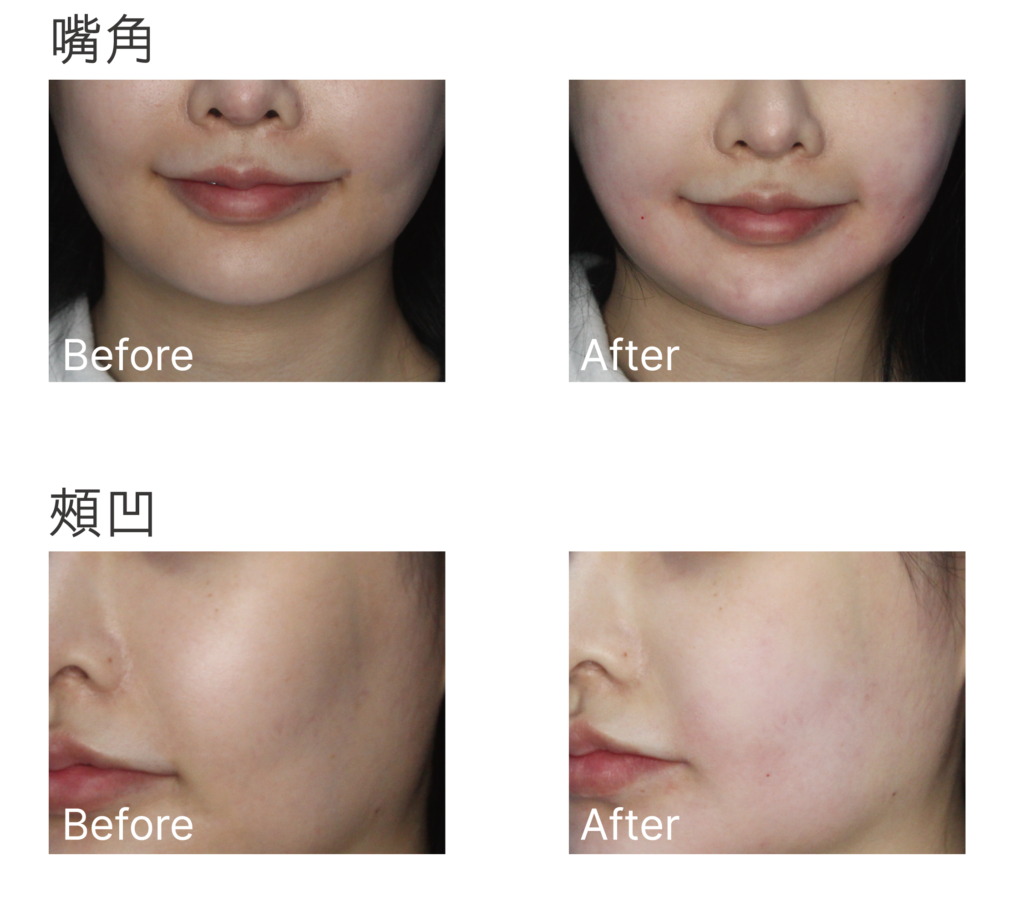 Initial Plus Medical Centre 卓優醫療診所 Belotero 瑞士透明質酸對比圖 3