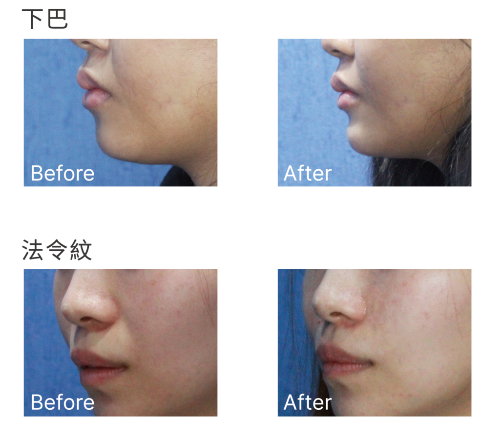 Initial Plus Medical Centre 卓優醫療診所 Belotero 瑞士透明質酸對比圖