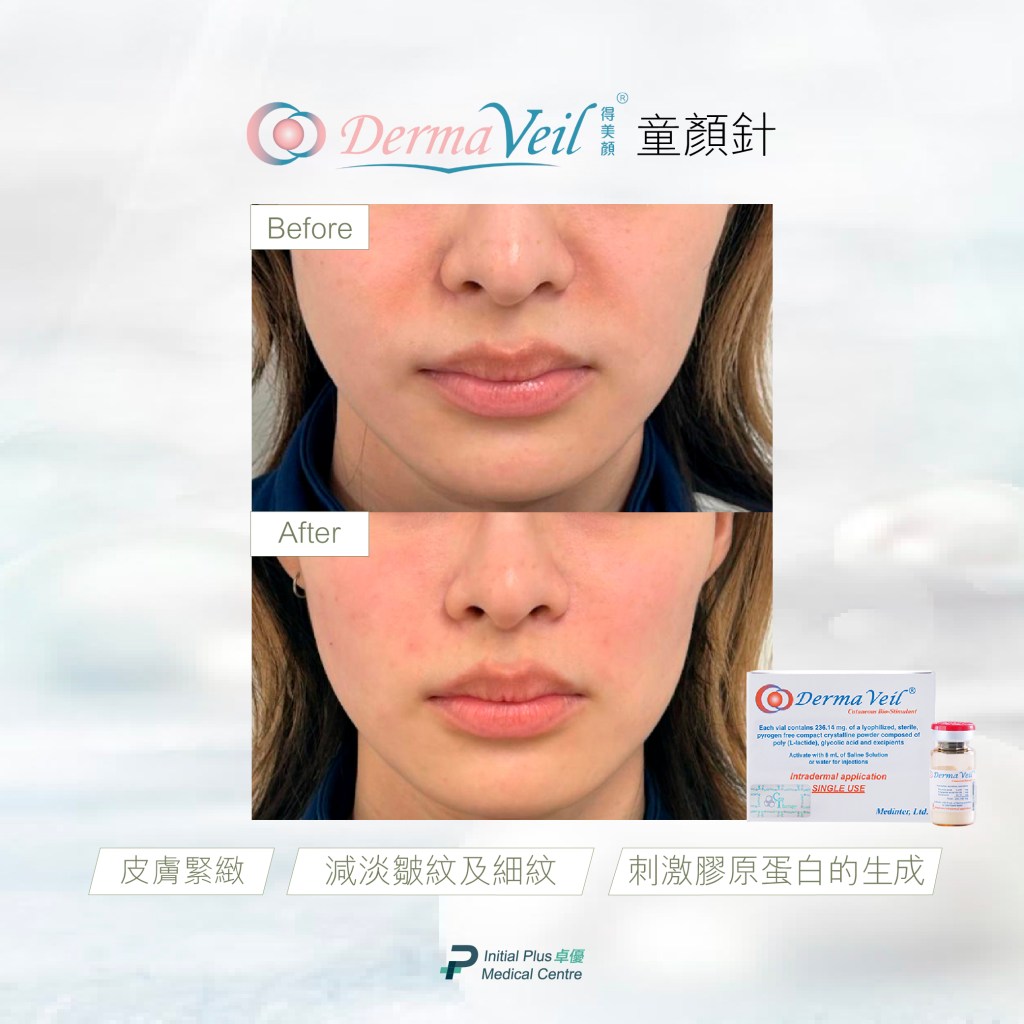 Initial Plus Medical Centre 卓優醫療診所 Derma Veil 童顏針對比圖
