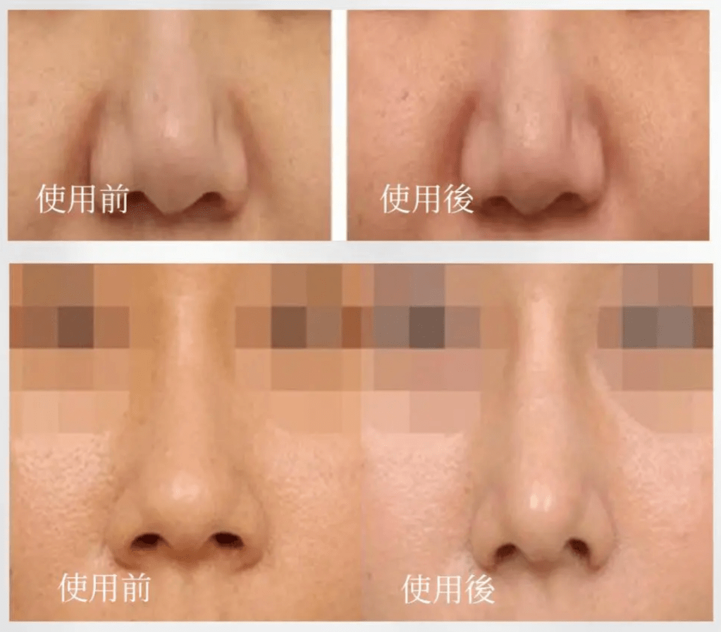 Initial Plus Medical Centre 卓優醫療診所 Fiola EyeBag 眼袋針對比圖