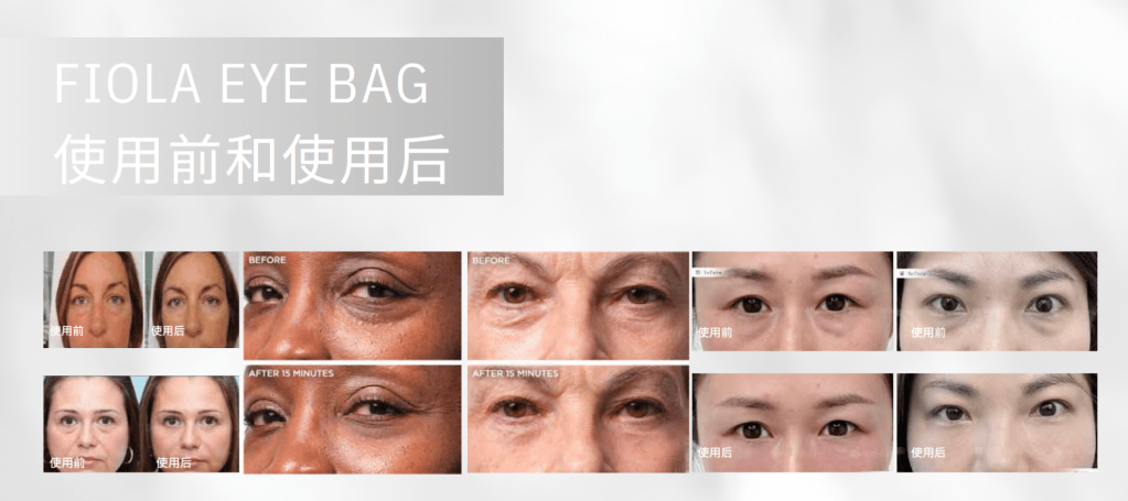 Initial Plus Medical Centre 卓優醫療診所 Fiola EyeBag 眼袋針對比圖2