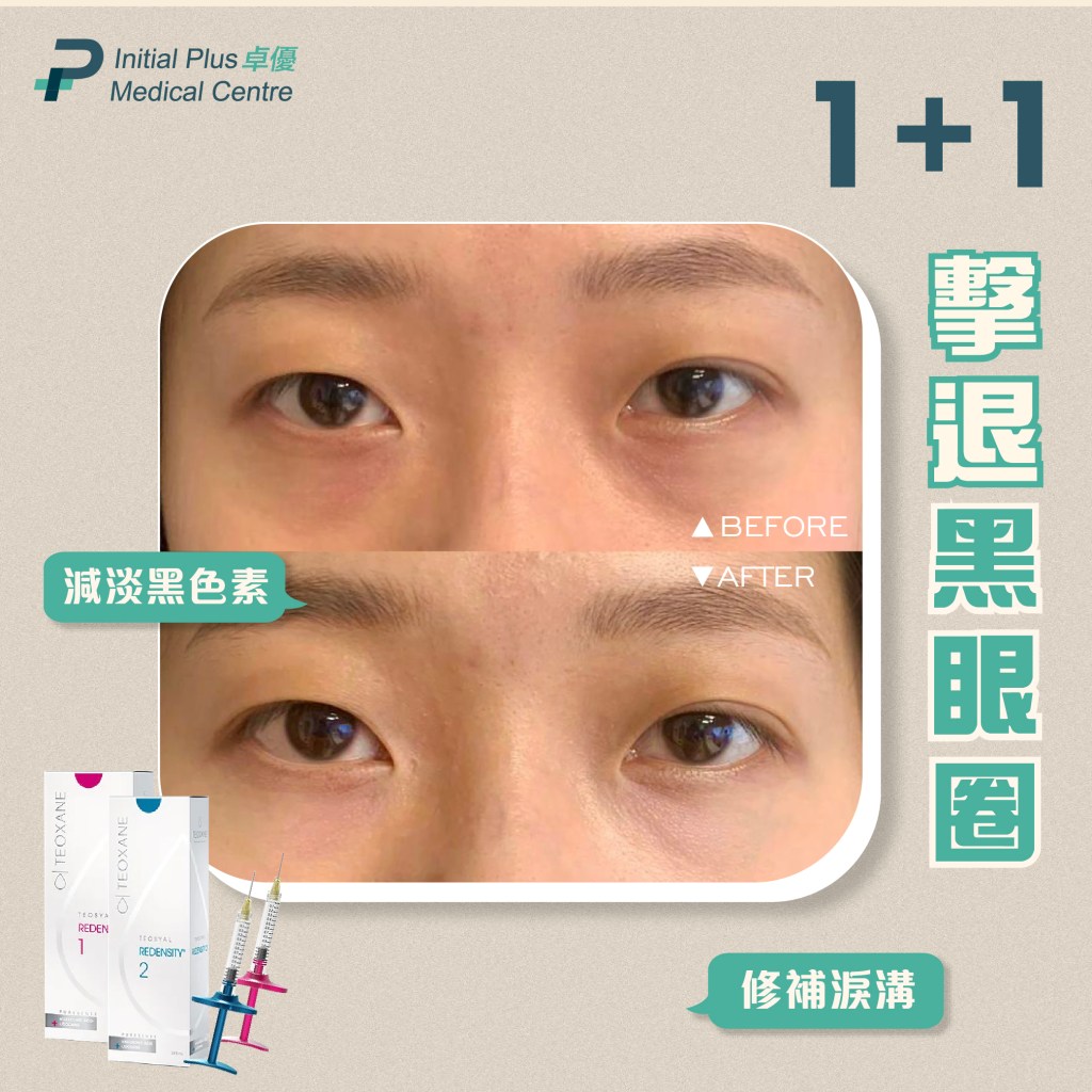 Teosyal Redensity 2 熊貓針 7 Initial Plus Medical Centre 卓優醫療診所 Teosyal Redensity 2 熊貓針對比圖