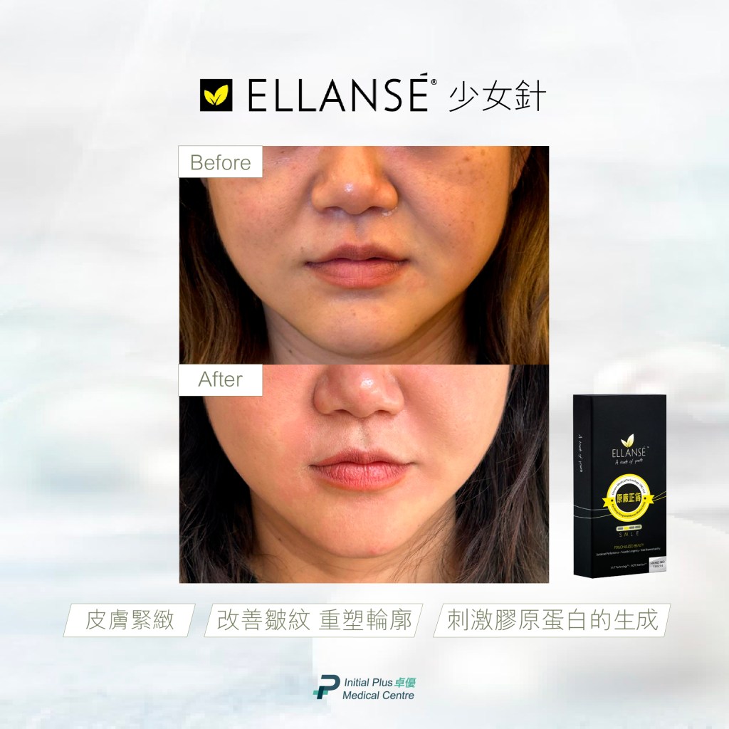 Initial Plus Medical Centre 卓優醫療診所 ellanse少女針對比圖