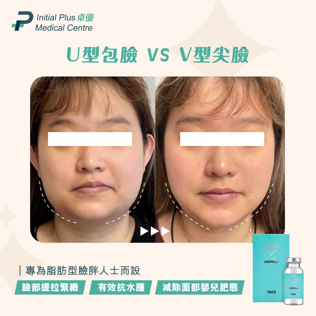 Initial Plus Medical Centre 卓優醫療診所 misfill face對比圖