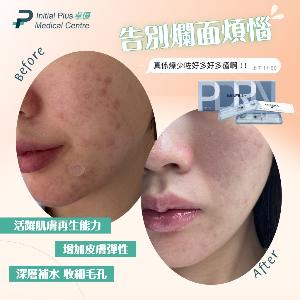 Initial Plus Medical Centre 卓優醫療診所 misfill水光針對比圖