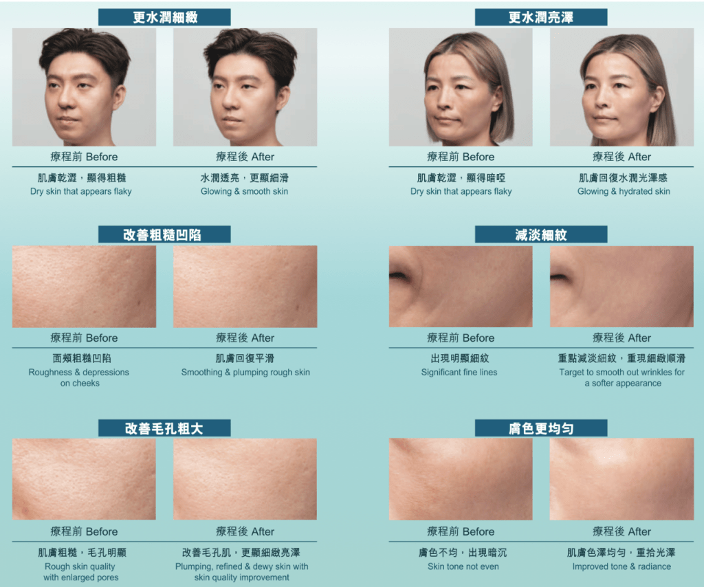 Skinvive 喬雅登長效水光針(昇光針) 8 Initial Plus Medical Centre 卓優醫療診所 skinvive對比圖