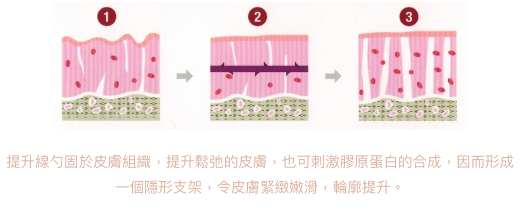 Initial Plus Medical Centre 卓優醫療診所 埋線原理