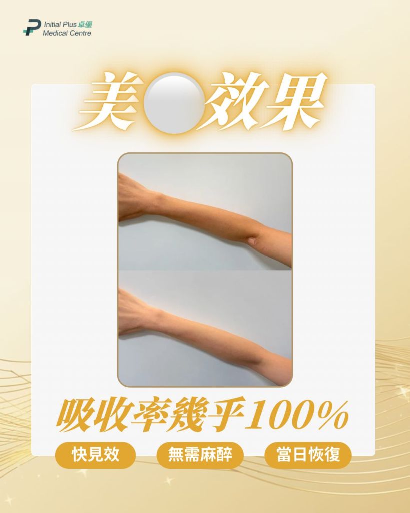 Initial Plus Medical Centre 卓優醫療診所 極光亮白綜合配方對比圖