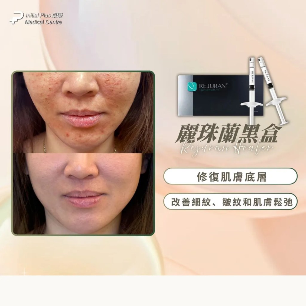 【Rejuran麗珠蘭4色懶人包】黑盒抗老、藍盒痘疤、白盒眼周、紅盒保濕一文看懂全解 8 Initial Plus Medical Centre 卓優醫療診所 Rejuran麗珠蘭4色懶人包d4fcfb26 64aa 4cb2 a78e 3b021f86bae0