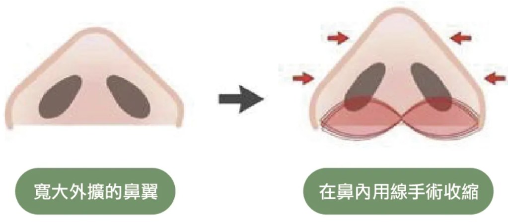 Initial Plus Medical Centre 卓優醫療診所 微創縮鼻翼原理