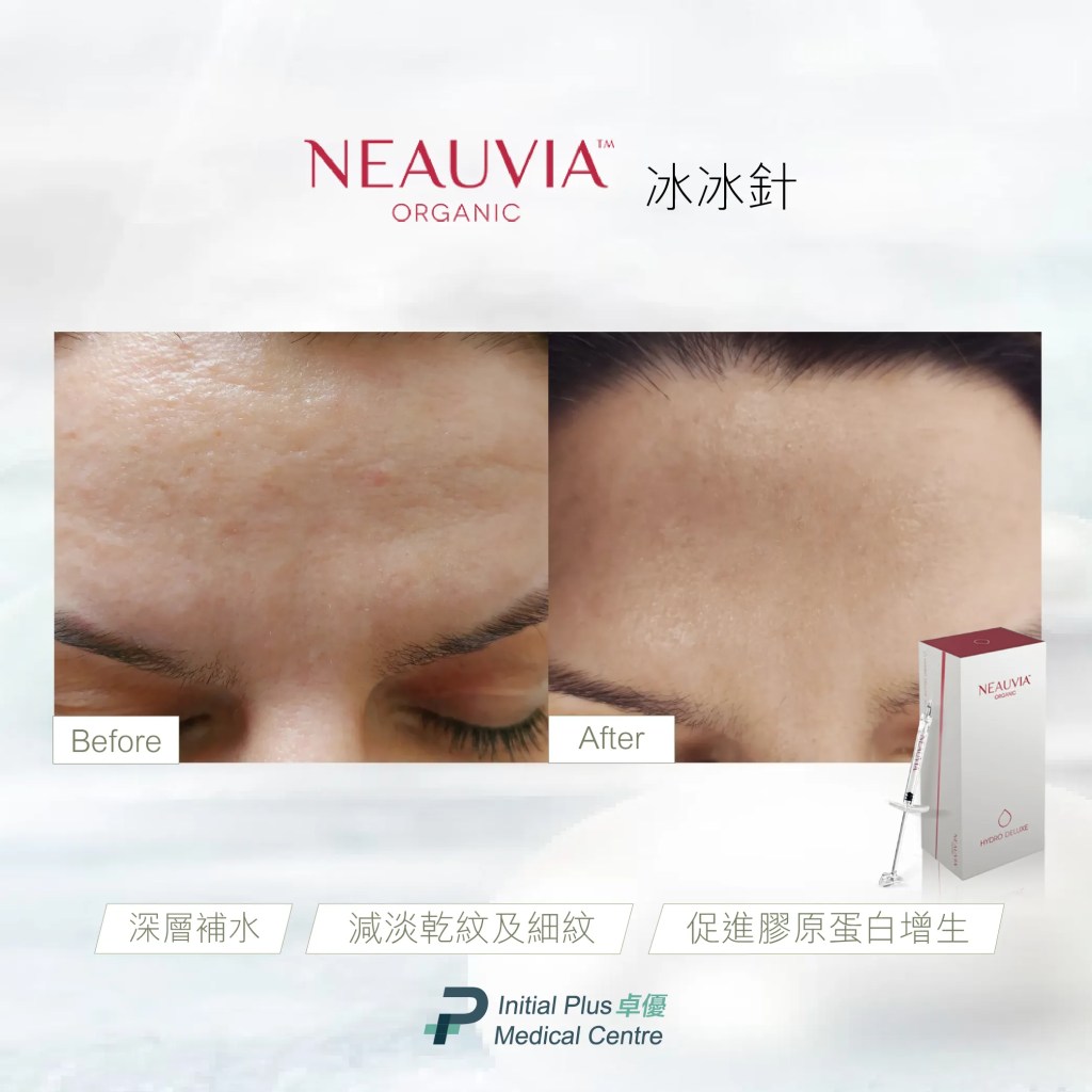 【水光針全攻略】麗珠蘭黑盒、Juvelook素顏針、冰冰針、Profhilo逆時針、Skinvive喬雅登昇光針、Misfill三文魚水光針,一文教你精準選擇最適合你肌膚的水光針 16 Initial Plus Medical Centre 卓優醫療診所 水光針全攻略neauvia BA