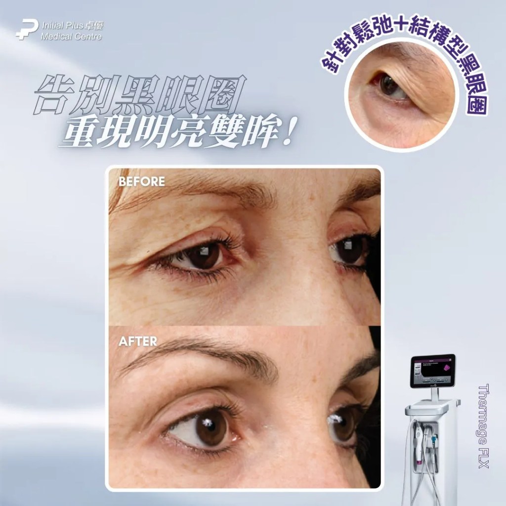 黑眼圈終極破解!Teosyal Redensity 熊貓針 vs Rejuran 麗珠蘭白盒 vs Thermage 眼周,完整指南助你徹底擺脫萬年黑眼圈 11 Initial Plus Medical Centre 卓優醫療診所 黑眼圈 熊貓針 vs 麗珠蘭 vs thermagedetail 1
