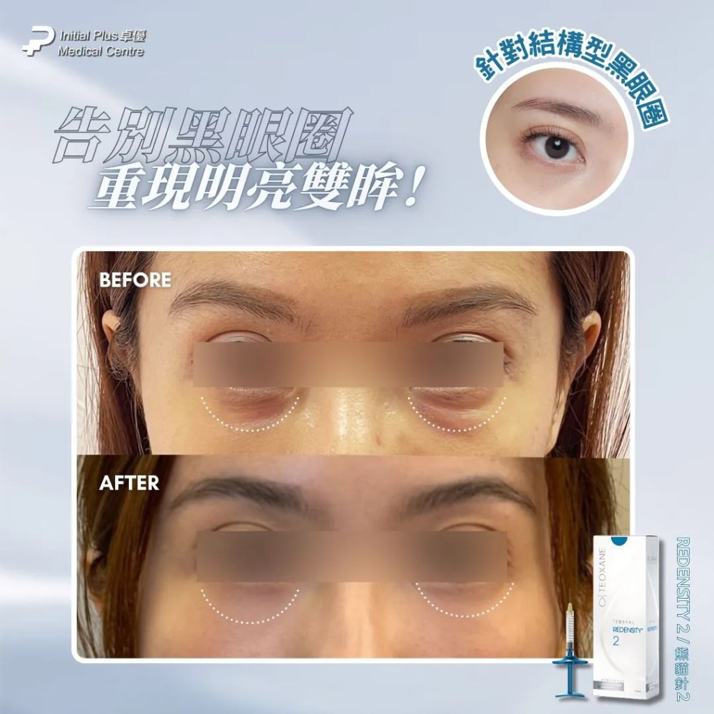 黑眼圈終極破解!Teosyal Redensity 熊貓針 vs Rejuran 麗珠蘭白盒 vs Thermage 眼周,完整指南助你徹底擺脫萬年黑眼圈 10 Initial Plus Medical Centre 卓優醫療診所 黑眼圈 熊貓針 vs 麗珠蘭 vs thermagedetail 3