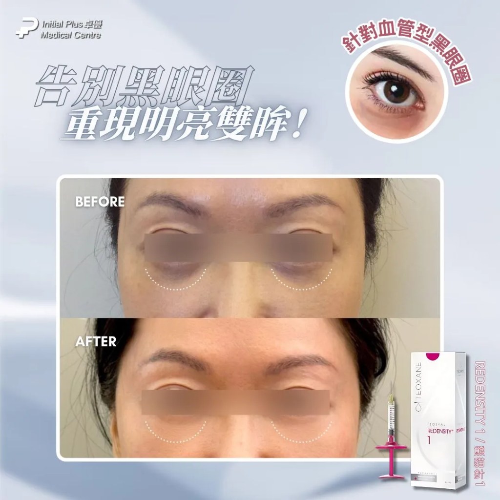 黑眼圈終極破解!Teosyal Redensity 熊貓針 vs Rejuran 麗珠蘭白盒 vs Thermage 眼周,完整指南助你徹底擺脫萬年黑眼圈 9 Initial Plus Medical Centre 卓優醫療診所 黑眼圈 熊貓針 vs 麗珠蘭 vs thermagedetail 4