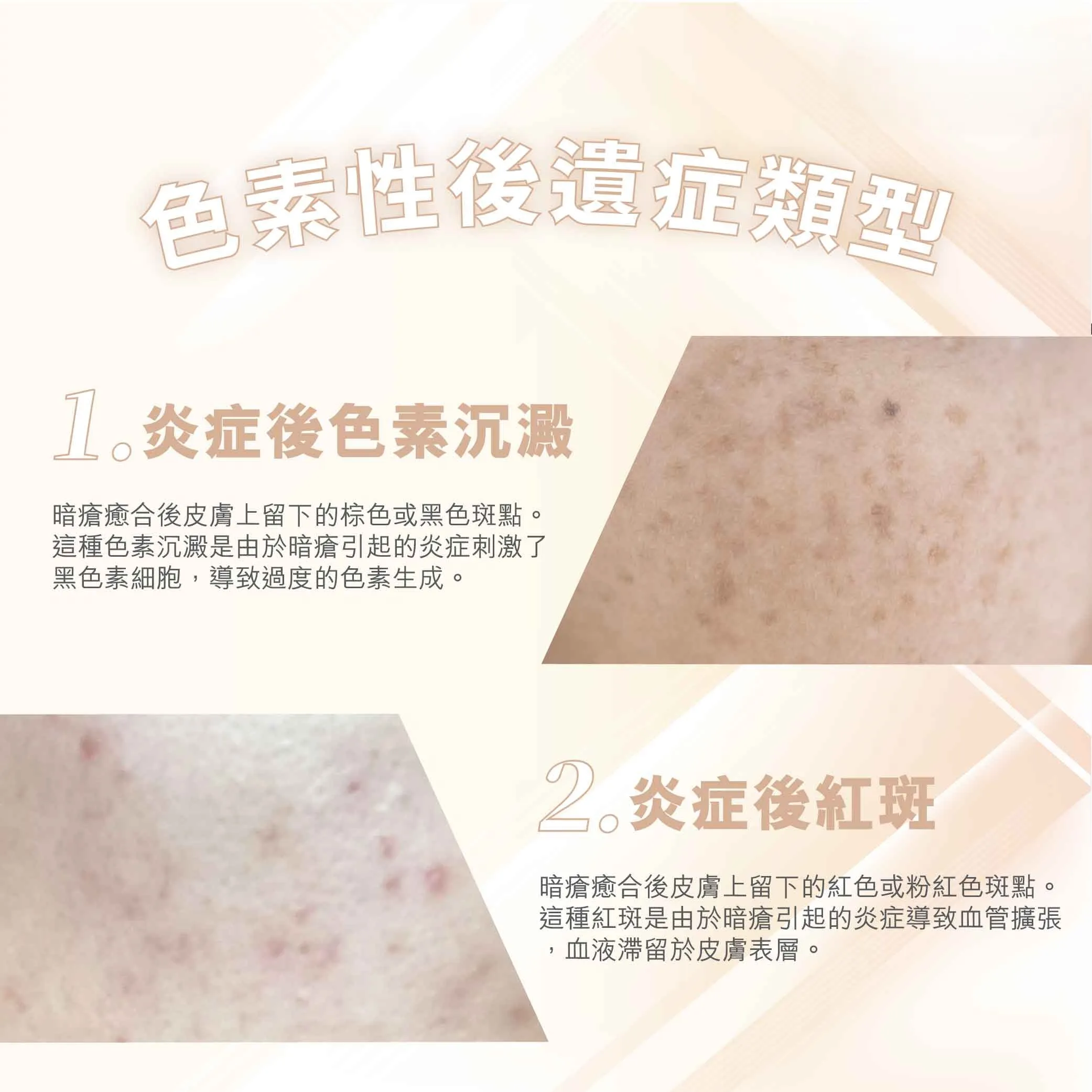 色素性後遺症的類型2