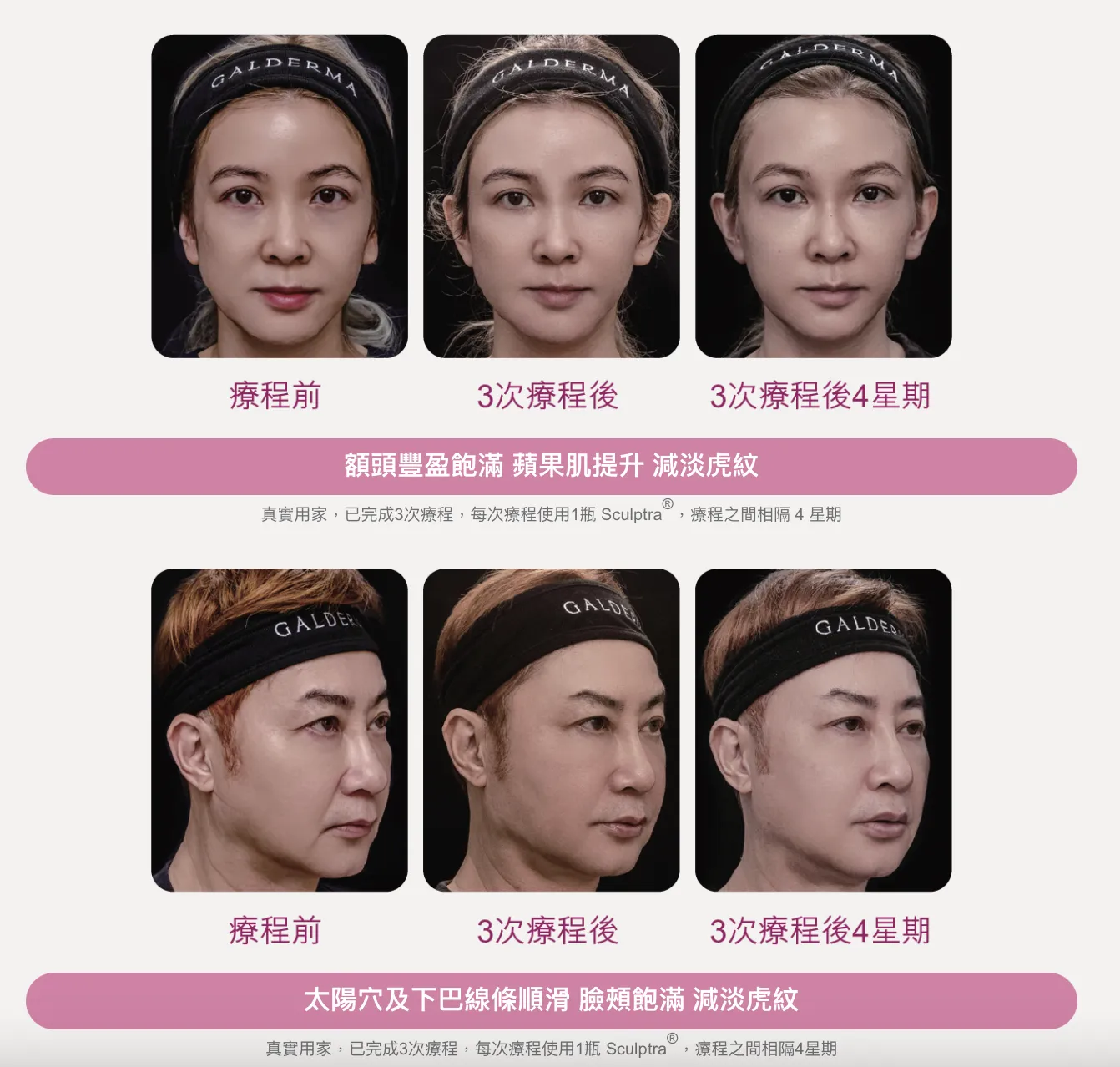 自然抗衰新選擇!Sculptra 童顏針如何重塑緊緻光澤肌? 2 螢幕截圖 2025 09 15 下午3.43.04