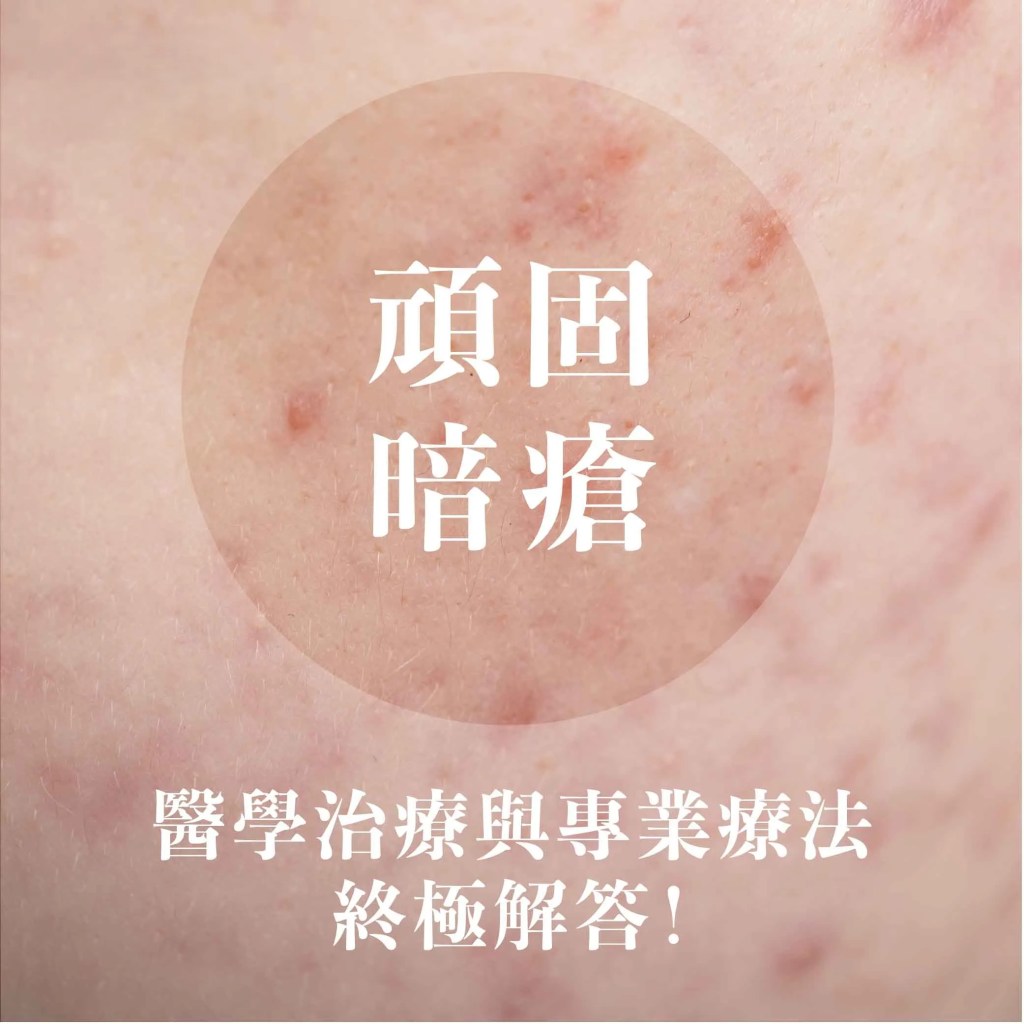 頑固暗瘡怎麼辦？醫學治療與專業療法的終極解答，教你如何打破痘痘惡性循環！cover