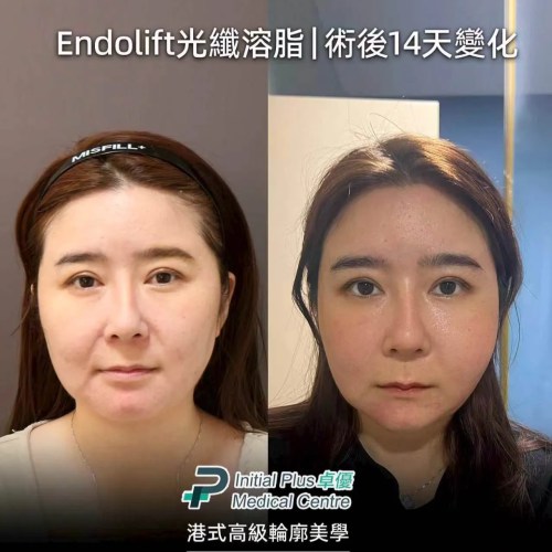 Endolift 療程